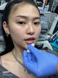 40 top Chin Filler ideas in 2025