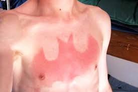 The european chemicals agency (echa) has warned that tattoo inks are potentially toxic, according to a study which could see many of them banned. Trendy Sunburn Tattoos Could Be Hazardous To Your Health Az Big Media