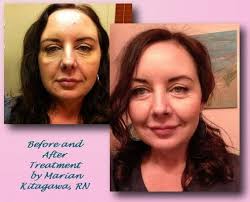 Marian, Aesthetic Nurse Specialist, 1748 Laurel St, San Carlos, CA 94070,  US