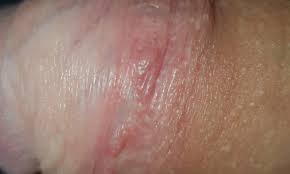 Es veränderte sich auch was an der vorhaut wo ich an der inneren seite der vorhaut jetzt oben eine hautgeschwulst oder sowas die man sieht wenn er steif ist habe. Zwei Haut Klumpen Am Penisschaft Gesundheit Und Medizin Sex Krankheit