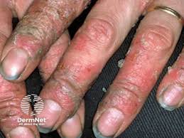 Image result for Contact Dermatitis