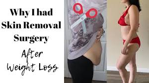 Pin On Extreme Weight Loss Journey