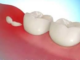 Hi , got my all 4 of my wisdom teeth out 7 months, but about 4 days ago i got sharp pain in my lower jaw bone , the surgen said he had to talk cartildge out from my jaw when he was doing the opporation, but i hadnt had any previous pain before hand, and now its starting to effect my other side. Warning Signs Of Impacted Wisdom Teeth Infinity Dental Clinic