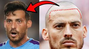 David Silva FUE Hair Transplant Transformation! How many grafts?