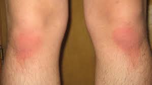 How Do You Treat A Rug Burn?