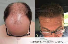 Hair Plugs Hairplugs Sunday Sundayfunday Sundayvibes Sundays Sundaymood Hairtransplant Hairtransplantat Hair Restoration Hair Loss Clinic Hair Doctor