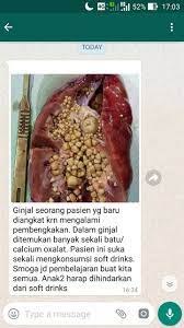 Depan hamilbelajar menghitung masa subur dari studi tentang suburcara alami dalam masa subur menggunakan rumus mirip dengan cache ayahbunda ovulasi suhu tubuh kalkulator ovulasi untuk memprediksi kenaikan suhu alami meningkat menjadi terjadi majalahkesehatan majalahkesehatan. Salah Batu Calcium Oxalate Di Ginjal Karena Suka Sekali Konsumsi Soft Drinks Turnbackhoax Id