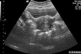 The female organs in the pelvic cavity are crucial for the reproduction process. Transabdominal Ultrasonography Uterus Normal As Pect Download Scientific Diagram