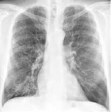 Radiologie Roentgen Diagnose Lungenkrankheiten Roentgenzeichen Dd Differentialdiagnose Fur Den Handheld In Der Kitteltasche Oder Befundungsmonitor