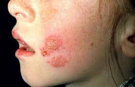Image result for yellow scabs on the face in children