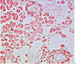 Cardiac amyloidosis (stiff heart syndrome) occurs when amyloid deposits take the place of normal heart. Pathologic Findings Of Amyloidosis Recent Advances Intechopen