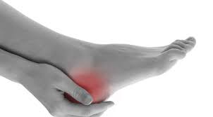 Plantar fasciitis adalah peradangan pada jaringan penghubung antar tulang (ligamen) di telapak kaki, tepatnya di antara tumit dan lengkungan kaki. Penyakit Nyeri Tumit Gejala Penyebab Pengobatan Klikdokter Com