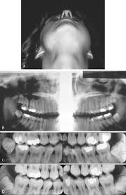 Osteosarcoma is a tumor composed of malignant approximately 5% to 7% of all osteosarcomas occur in the jaws. Sarcomas Of The Jaws Pocket Dentistry