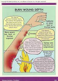 Burn Wounds Treat Light Wounds With Cool Water Bigger Wounds With Cold Damp Wraps Aft Avec Images Etudiantes En Ecole D Infirmiere Etudiants En Medecine Soin Infirmier