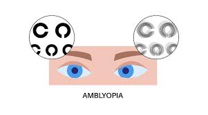 Image result for Amblyopia