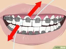 The spatula end of the flosser can easily fit underneath the braces wire, and enables the user to floss like normal. 4 Ways To Floss With Braces Wikihow