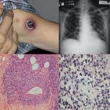 Escharotomy simply means opening the eschar. A Cutaneous Sore With Black Eschar In A Cowhide Worker The Lancet