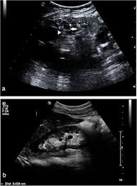 Renal ultrasound (us) is the most appropriate method for imaging renal failure; Ultrasound To Address Medullary Sponge Kidney A Retrospective Study Bmc Nephrology Full Text