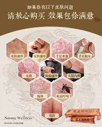 苗王癣毒膏针对以下皮肤问题の独家配方 皮肤湿痒 皮肤瘙痒 手足水泡 手足脱皮 阴囊瘙痒 大腿内侧 蚊虫叮咬 皮癣 疱疹 股癣