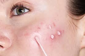 Ultimate Solutions For Acne Prone Skin Cult Beauty