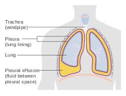 A role in selected clinical circumstances. Pleural Effusion Wikipedia