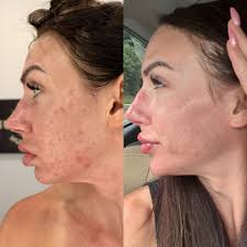 ✨ Just look at this transformation! ✨ In only two months, this patient's  skin has changed so much. She's been dedicated to her routine — biweekly  facials, Omnilux LED light therapy, and