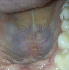 Oral cancer or oropharyngeal cancer (includes tissues of the base of the tongue, tonsils, soft palate and walls of the throat), is the largest part of did you know that the risk of developing oropharyngeal cancer increases by 100% if you are a drinker and a smoker? How Common Is Hpv Reddit