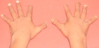 Check spelling or type a new query. Hands Showing Short Stubby Spoon Shaped Digits With Dystrophic Nails Download Scientific Diagram