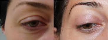 În plus față de toate cauzele enumerate de umflare a ochilor, există, de asemenea, un astfel de motiv ca tumori benigne edemul în unul dintre pleoape (superioară sau inferioară) a unui singur ochi indică prezența unor boli posibile de tipul următor Blefaroplastia Chirurgia Pleoapelor Doctor Sorin Nae