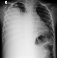 Effusion dökme effusion gases sızıntı gazlar effusion akıtma ne demek. Pleural Effusion Large Right Sided Radiology Case Radiopaedia Org