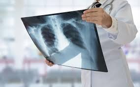 L'immunothérapie est une méthode de traitement permettant de lutter contre toutes sortes de maladies et notamment le cancer, en administrant des médicaments qui vont activer et mobiliser les défenses. L Immunotherapie Double Les Chances De Survie En Cas De Cancer Du Poumon Avance Sante 7sur7 Be
