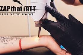 Get smooth at laseraway in valencia, ca. Zap That Tatt Laser Tattoo Removal Posts Facebook