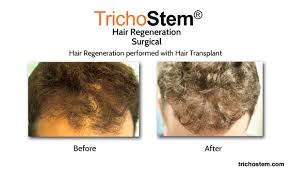 / 4 comments / october 9, 2014 february 1, 2021 / baldness cure, baldness stem cells, baldness treatment, cure for baldness, densifique, fda l'oreal, fda lancome, kérastase densifique, l'oreal stem cells, lancome stem cells, patricia pineau, stem cells baldness, stemoxydine / baldness, blog Main Causes Hair Loss In Men And How To Treat Trichostem