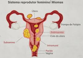 Miomas Uterinos: Sintomas, Diagnóstico e Tratamentos