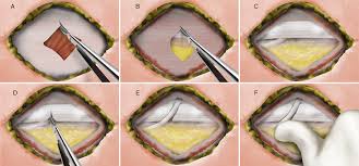 Maybe you would like to learn more about one of these? Surgical Treatment Of Middle Cluneal Nerve Entrapment Neuropathy Technical Note In Journal Of Neurosurgery Spine Volume 29 Issue 2 2018