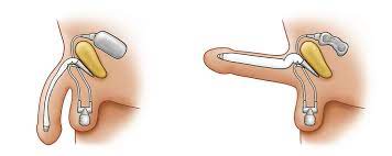 Reconstrução, quando por algum motivo o paciente perde uma parte do órgão (acidente ou doença) e a de aumento de pênis, quando o tamanho do órgão é inferior a 12 centímetros ereto. Why Zsi For Transgender People Zephyr Surgical Implants