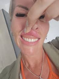 How soon after implants can u wear removable dentures