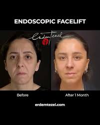 İzsiz Kıkırdak Tespiti ile burna dışarıdan kesi yapmadan burna şekil verme  * Rhinoplasty procedures provide more natural results and reduce the need  for second surgeries for patients using the traceless cartilage fixation