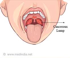 It can be difficult to detect throat cancer in its early stages. What Causes Pharyngeal Cancer