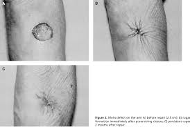 Image result for Purse String Suture