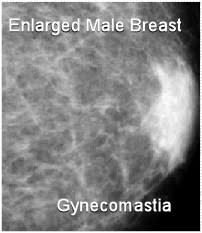 Many people do not realize that men have breast tissue and that they can develop breast in dcis (also known as intraductal carcinoma), cells that lined the ducts have changed to look like cancer cells. Mammogram Images And Ultrasound Explained By Moose And Doc