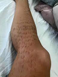 I have had lhr on several occasions but never with this laser technician and never with this… How Laser Hair Removal Left One Woman Scarred Realself News