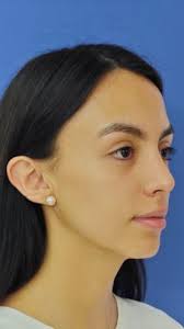 Rinoplastia en Ciudad Satélite