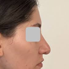 LARRY S NICHTER, MD MS ,FACS