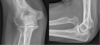 Image result for Radial Head Dislocation