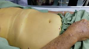 We did not find results for: 8 Gejala Penyakit Kuning Pada Orang Dewasa Kenali Penyebabnya Hot Liputan6 Com