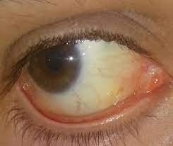 Leicht Gelbliche Augen Gesundheit Medizin Leber