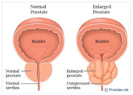 Bladder cancer is the fifth most common form of cancer. 5 Symptoms Of Bladder Cancer Every Woman Should Know Health Nigeria