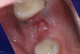 Although having a tooth pulled is usually very safe, the procedure can allow harmful bacteria into the bloodstream. Keys To Predictable Socket Grafting Part 1 Oral Health Group