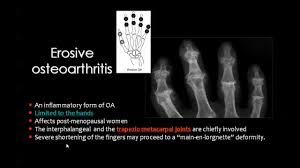 Pin By Dr Abuaiad On Bone And Joints Bone And Joint Osteoarthritis Arthritis